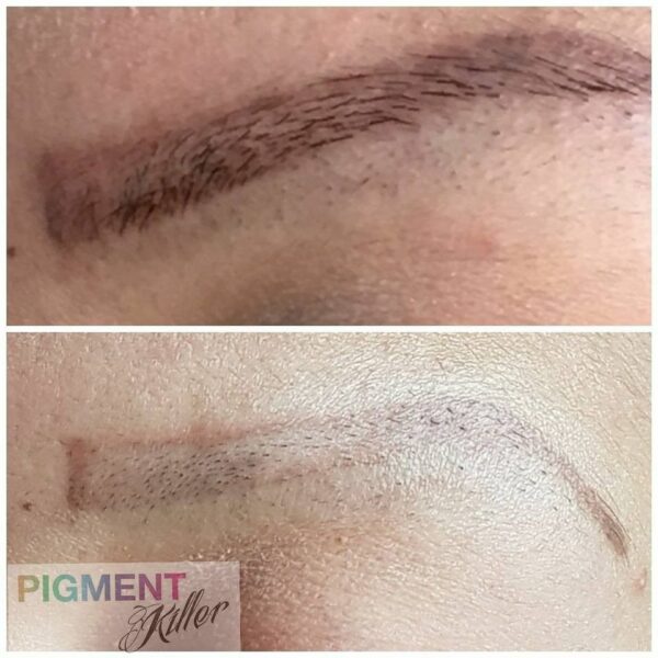 Pigment Killer Kit Complet - imagine 4